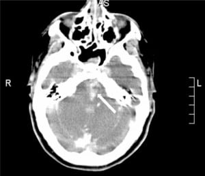 Figure 3. Post-thrombectomy head computed tomography. There is a high density signal in the left pons (solid arrow) consistent with a left pontine intraparenchymal hemorrhage. This imaging study also showed development of an intraparenchymal hemorrhage involving the left cerebral peduncle (image not shown).