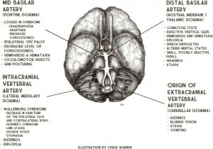 Figure 4. Vertebrobasilar circulation occlusions. The arteries of the vertebrobasilar circulation are illustrated. The area of ischemia and associated symptoms caused by occlusion of the major arteries are listed.