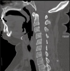 Figure 1. Lateral c-spine sagittal reconstruction from the computed tomography.