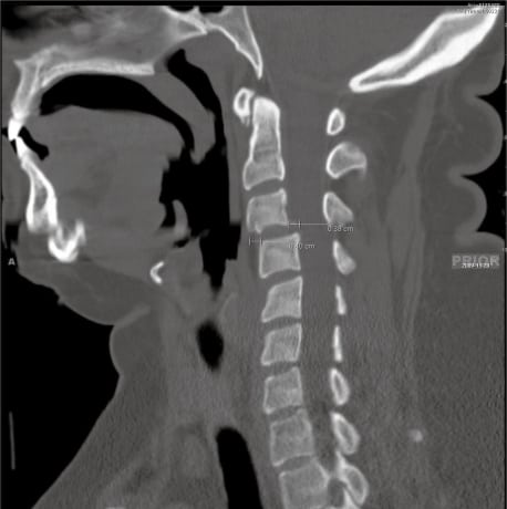 Artifact Simulating Fracture on Cervical Spine Computed Tomography