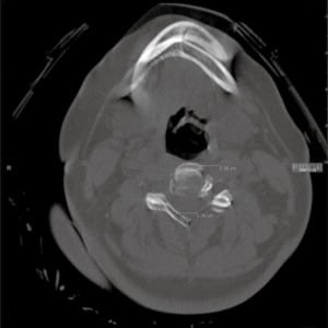 Figure 2. Axial image from the computed tomography at C3–C4.