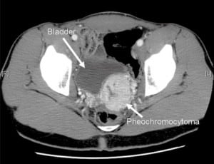 Figure 2. Computed tomography showed a 5.6 × 4.7 cm mass in the left pelvis along the posterior dome of the bladder, which was consistent with a pheochromocytoma, given its location and the clinical picture.