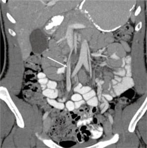 Figure. Computed tomography with contrast of the abdomen/pelvis showed a non-occlusive thrombosis of the superior mesenteric vein.