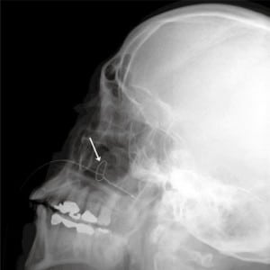 Figure 1. Lateral radiograph of the skull demonstrating the knotted nasogastric tube.
