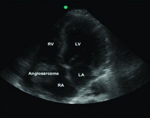 Figure 1. Apical 4-chambers view reveals a 5-cm hyperechoic mass in right atrium.