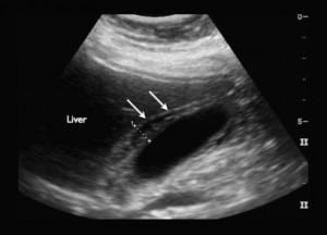 Figure. Longitudinal view of gallbladder with thickened anterior wall calipers with mild pericholecystic fluid (arrows). The common bile duct was measured to be 4 mm in diameter.