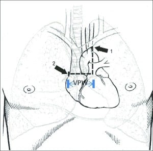 Figure 1. The vascular pedicle width is measured by 1, dropping a perpendicular line from the point at which the left subclavian artery exists the aortic arch and 2, measuring across to the point at which the superior vena cava crosses the right mainstem bronchus. Produced with permission from Ely et al.