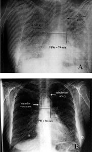 Figure 2. A, A portable chest radiograph (CR) of a 52-year-old woman with pulmonary edema who has a vascular pedicle width (VPW) measured at 79 mm. B, The same patient after having 10,900 mL net fluid removed 10 days later. Portable CR showed a VPW of 56 mm. Figure adapted and produced with permission from Ely and Haponik.