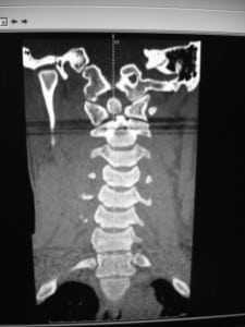 Figure 1. Noncontrast computed tomography of cervical spine. This shows an unfused dens (os odontoideum).
