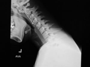 Figure 3. Flexion view of plain cervical spine. This image shows abnormal translation of the articulation between C1 and the C2 os odontoideum in relation to the remainder of the C2 vertebral body.
