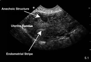 Figure 1. Endovaginal sagittal view of the anteverted uterus with the fundus oriented to the left side of the image. The anterior portion of the uterus shows an anechoic structure signifying the arteriovenous malformation.