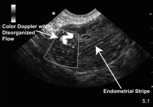 Figure 2. Endovaginal sagittal view of the anteverted uterus with the fundus oriented to the left side of the image. The area seen in Figure 1 now enhanced with color Doppler. Note the disorganized to and fro flow pattern consistent with arteriovenous malformations.