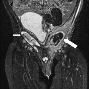 Figure 1. This coronal T2 weighted magnetic resonance image of the patient demonstrates a normal homogenous right undescended testicle (small arrow) and a heterogeneous inflamed left undescended testicle (large arrow).