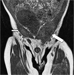Figure 2. This coronal T1 weighted magnetic resonance image of the patient demonstrates a normal homogenous right undescended testicle (small arrow) and a heterogeneous inflamed left undescended testicle (large arrow).