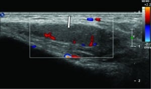 Figure 3. Transverse color Doppler image of the patient's right testicle demonstrates uniform echogenicity and flow throughout the testicle.