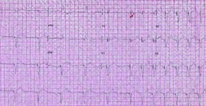 Figure. Twelve-lead electrocardiogram shows sinus tachycardia with evident 2:1 block of paced beats followed by 1:1 atrioventricular synchronous pacing at 118 beats per minute.