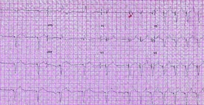 Pacemaker Limitation of Tachycardia in Hypovolemic Shock
