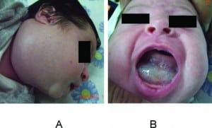 Figure 1. A, Cystic hygroma on the right side of the neck. B, The lesion is infiltrating the oral cavity and displacing the tongue upward.