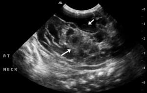 Figure 2. Sonographic longitudinal view of the right neck. A large mass is seen (arrows), insinuating around the normal structures of the neck. The mass is partially anechoic (cystic) and partially shows mixed echogenicity with septae of variable thickness.