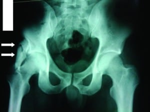 Figure. Pelvic radiograph in anteroposterior projection. Double arrows indicate myositis ossificans.