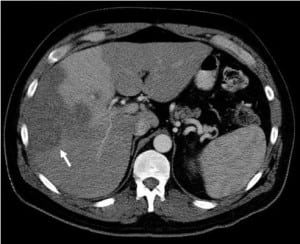 Figure 1. Abdominal computed tomography showing low attenuation masses in the right lobe of the liver with differential perfusion.