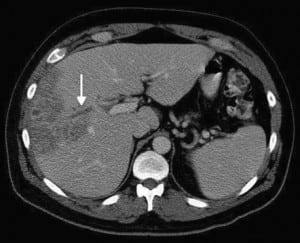 Figure 2. Thrombus in the right portal vein.