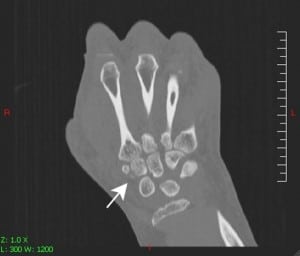 Figure 1. Coronal view computed tomography of wrist demonstrating trapezoid fracture.