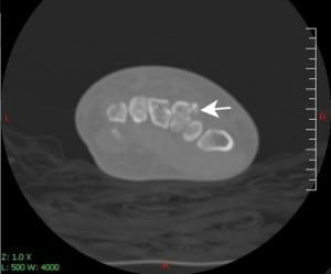 Figure 2. Axial view computed tomography of wrist demonstrating comminuted trapezoid fracture.