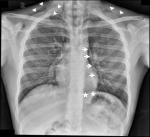 Figure. Spontaneous pneumomediastinum seen on a chest radiograph. Arrows indicate detachment of the parietal pleura from the major mediastinal vessels and the pericardium; stars, the continuous diaphragm sign; arrowheads, air lines in the mediastinum and in the subcutaneous tissues of the neck.