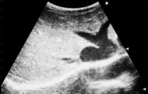 Figure 1. Ultrasonography of the liver showing “Playboy Bunny” sign in a 32-year-old man with congestive heart failure.