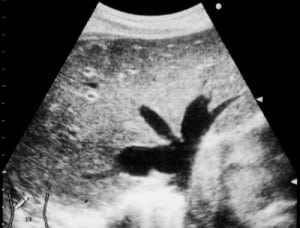 Figure 2. Ultrasonography of the liver showing “Playboy Bunny” sign in a 62-year-old woman with congestive heart failure.