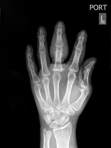 Figure 2. Radiograph of the patient's hand demonstrating periosteal elevation consistent with osteomyelitis.