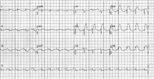 Figure. The 12-lead electrocardiogram showing extensive septal-anterior-lateral ST-elevation myocardial infarction.