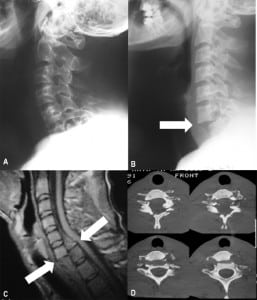Figure. A, Initial radiography showing the lateral view of the cervical spine. No significant injuries are depicted, but the lowest cervical vertebra is not seen. B, The repetition of the radiography including the whole cervical spine disclosed a fracture dislocation C6 to C7 injury. C, Magnetic resonance image (sagittal view) showing a dislocation of the C6 vertebral soma anterior to the C7 vertebra, associated to a bilateral fracture of the pedicles of C6 and the posterior elements. The medullary cord is significantly displaced but shows no signs of injury. D, Computerized tomography (axial view) showing a significant anterior displacement of the vertebral soma as well as a fracture dislocation with involvement of both the vertebral pedicles and the laminae, which determined a widening of the medullary canal.