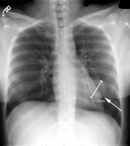 Figure 1. Supine anteroposterior chest radiograph showing (arrow) a 6 × 8-cm focal mass in the left lung base.