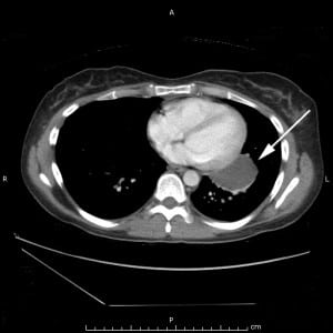 Figure 2. Chest computed tomographic scan with intravenous contrast obtained 17 months previously and showing (arrow) a 4.5 × 2.8-cm, well-defined, encapsulated fluid collection contiguous with the left heart border.