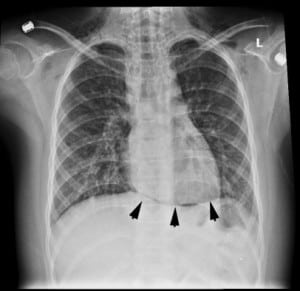 Figure 1. Frontal chest radiograph. The diaphragm is not obscured by the inferior heart border (black arrows).