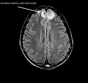 Figure 2. Magnetic resonance imaging of the brain showing frontal lobe contusions.