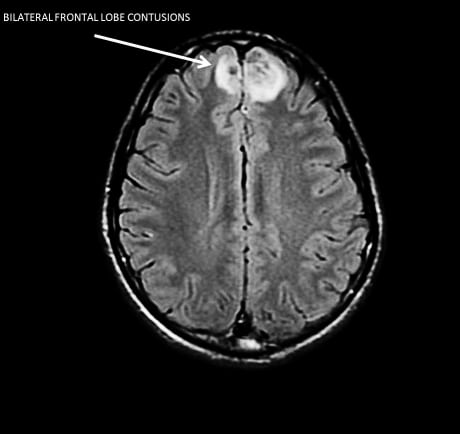Unilateral Internuclear Ophthalmoplegia after Minor Head Injury
