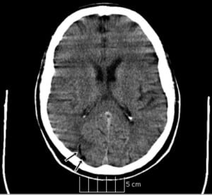 Figure 1. Head computed tomography showing multiple foci of air embolism as indicated by arrows.