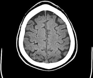 Figure 2. Head computed tomography showing multiple foci of air embolism as indicated by arrows.
