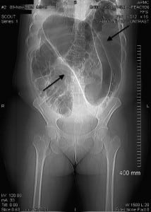 Figure 1. Computed tomography of abdomen showing “coffee bean sign.”