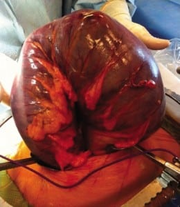 Figure 2. Intraoperative findings revealing sigmoid volvulus.