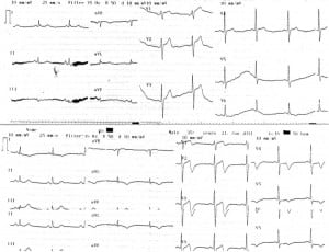 Figure 1. ECG of the patient at presentation showing tall, positive T wave in lead V1 (upper trace). ECG of the patient 4 h later showing biphasic T-wave inversions in right precordial leads and deep negative T-wave inversions in left precordial leads. There is no significant ST segment elevation or R progression loss (lower trace).