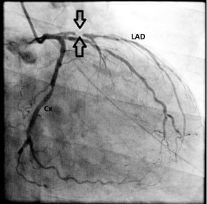 Figure 2. Coronary angiography showing critical, high-grade narrowing of the proximal left anterior descending coronary artery (between arrows). LAD, left anterior descending coronary artery; Cx, circumflex artery.