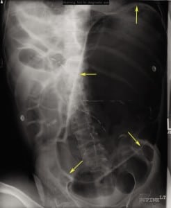 Figure 1. Abdominal radiograph showing massive gastric distension outlined by arrows.
