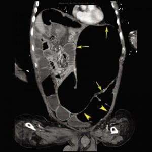 Figure 2. Coronal computed tomography demonstrating the massively dilated stomach (arrows) and dilated bowel loops (arrowheads).