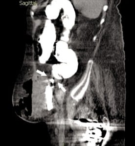 Figure. Sagittal reconstruction of abdominal computed tomography showing connection of abscess with the sigmoid colon (white arrows).