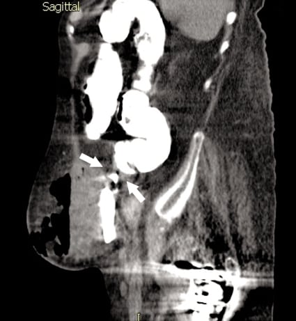 Right-Sided Sigmoid Diverticular Perforation