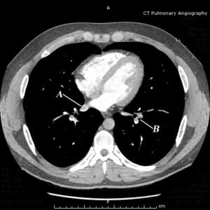 Figure 1. Axial section from the computed tomographic pulmonary angiogram demonstrating, A, filling defect in the right inferior pulmonary vein, in addition to, B, pulmonary emboli on the left.